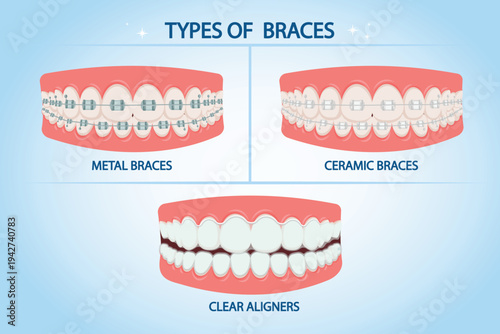 A mouth with various types of braces: metal and ceramic. Dental services, orthodontic treatment and teeth alignment. A smile with white and straight teeth for medical posters. Vector illustration