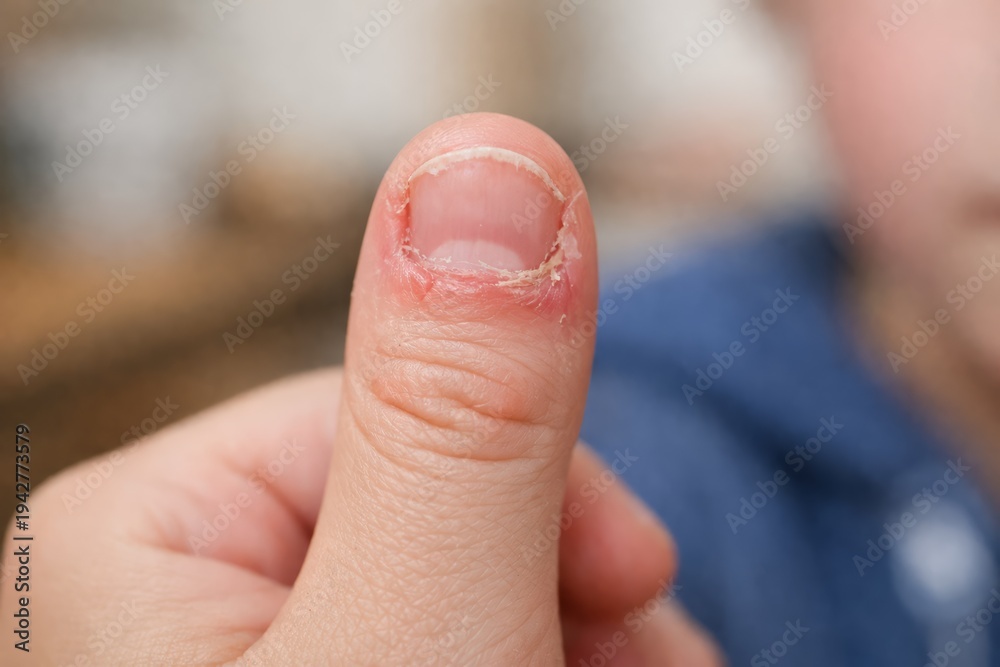 Naklejka premium Severely bitten thumb nail with red damaged skin