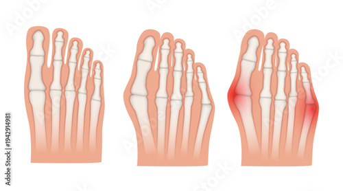 Hallux valgus. Valgus deformity of the big toe and little toe joint. Vector illustration.