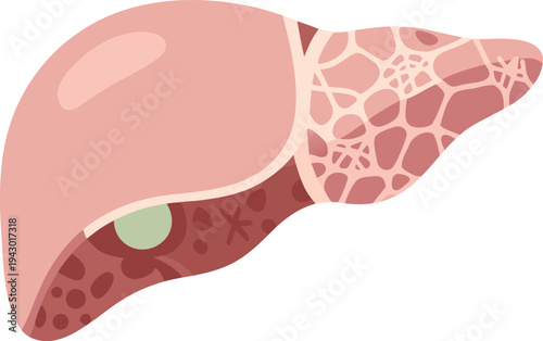 Medical illustration of a human liver showing damaged areas covered with pale scar tissue patterns, representing cirrhosis, chronic liver disease, and organ fibrosis