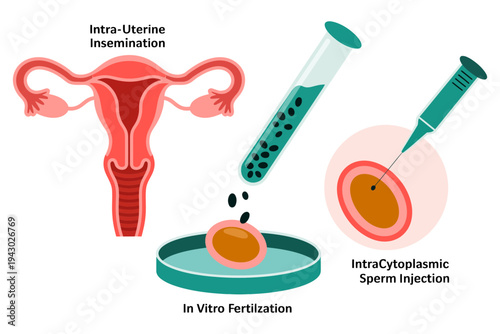 Fertilization vector illustration showing intrauterine insemination process