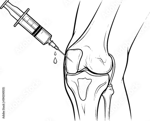 Black and white of a medical syringe injecting fluid into a human knee joint injection
