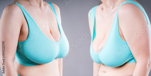 Billede på lærred Before and after of curvy woman with large breasts, bad and good posture, concep
