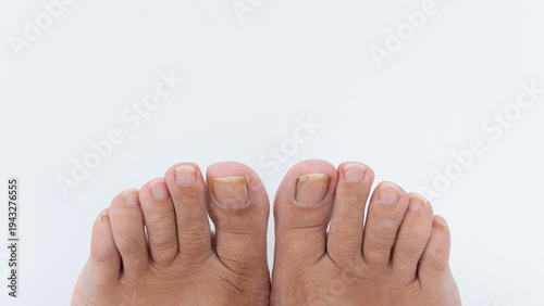 Close-up view of human feet showing ingrown toenails on big toes, highlighting foot health issues and personal care in a clean environment