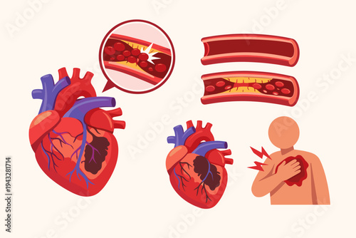 Medical illustration of heart attack pathology and atherosclerosis showing blocked coronary artery with plaque buildup, myocardial infarction, chest pain symptoms, and healthy vs diseased blood vessel