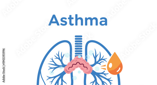 Asthma medical illustration showing human lungs with inflamed airways and bronchial tubes.