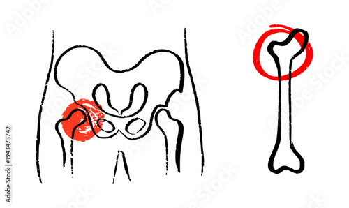Osteomyelitis disease sketch