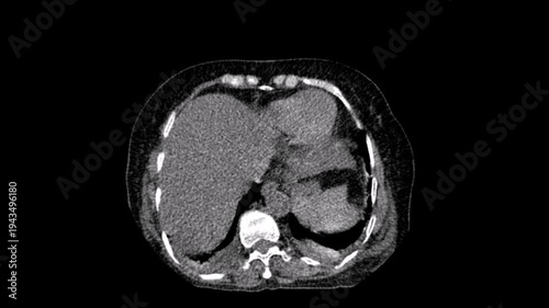 An ectopic kidney,abdomen ct scan
An ectopic kidney, also known as renal ectopia, is a congenital renal anomaly characterized by the abnormal location of one or both of the kidneys. Computed tomograp
