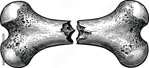 Broken bone or fractured leg bone medical drawing in a vintage woodcut style
