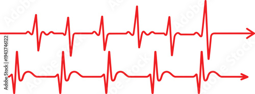 Electrocardiogram showing irregular heart rhythms with two distinct traces isolated on transparent background, Vector