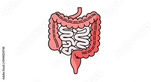 Detailed medical illustration of the human digestive system showing the large and small intestines in red and pink.