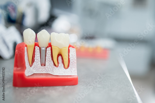 Anatomical model of a jaw, teeth, implants, implant placement, dental implantation. Close-up of dental instruments, a probe, and a mirror. Titanium screw.