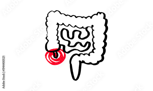 Inflamed appendix scetch