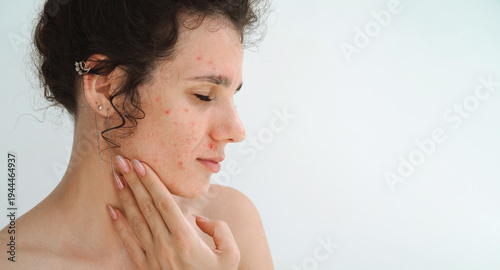 portrait of a young teenage girl with pimples and acne on problematic facial skin. Face of adult woman with bad inflamed skin in close-up on a white isolated background