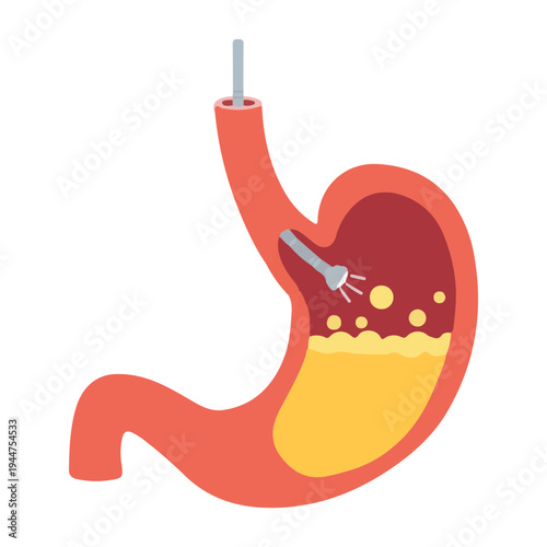Stomach Endoscopy Procedure