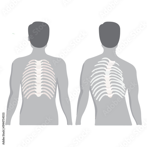 Normal and Scoliosis Spines