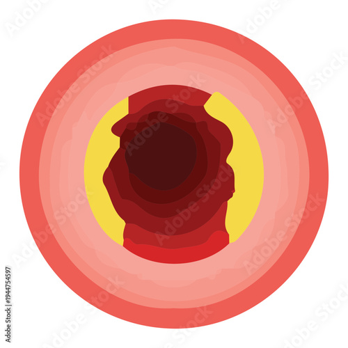 Atherosclerosis Concept