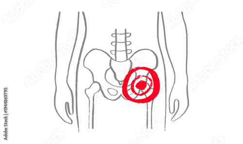 Osteomyelitis disease sketch