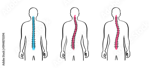 Scoliosis spine deformity