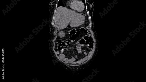 An ectopic kidney,abdomen ct scan
An ectopic kidney, also known as renal ectopia, is a congenital renal anomaly characterized by the abnormal location of one or both of the kidneys. Computed tomograp
