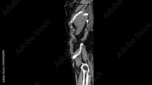 An ectopic kidney,abdomen ct scan
An ectopic kidney, also known as renal ectopia, is a congenital renal anomaly characterized by the abnormal location of one or both of the kidneys. Computed tomograp
