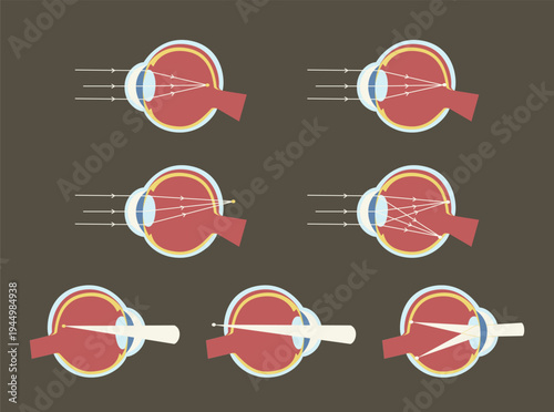 Vision Defects Myopia Hyperopia Astigmatism Eye Anatomy Illustration Set