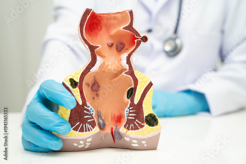 Fotografija Asian doctor with rectum and hemorrhoid human anatomy model at hospital, inflamed vascular structure