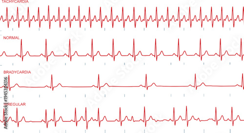 ECG heartbeat waveform comparison chart, tachycardia normal rhythm bradycardia and irregular heartbeat electrocardiogram medical diagnostic monitoring illustration