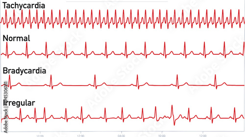 Electrocardiogram ECG heart rhythm comparison chart, tachycardia normal rhythm bradycardia and irregular heartbeat medical cardiology monitoring waveform illustrationElectrocardiogram ECG heart rhythm