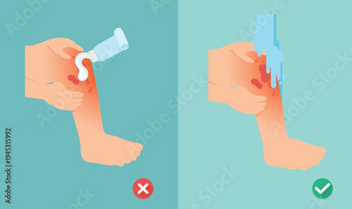 wrong and right skin burn first aid