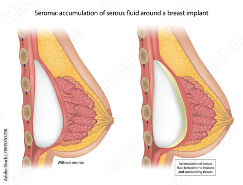Medical illustration showing seroma formation around a breast implant in cross section view. Normal breast implant placement without complications and accumulation of serous fluid between the implant 