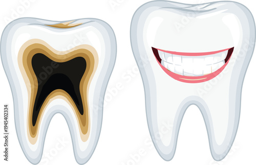 Tooth decay and healthy tooth comparison concept, dental care hygiene cavity prevention medical illustration flat vector illustration