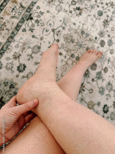 Swollen right leg. Vertical. Edema during pregnancy or kidney disease. Women's feet
