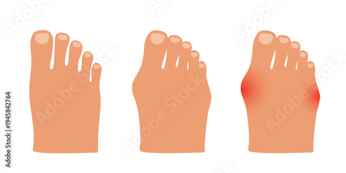 Hallux valgus of the little toe and big toe. Valgus deformity of joint. Vector illustration.