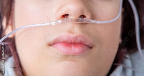 Bilde på lerret teenager male Patient with oxygen nasal cannula, respiratory support therapy, br