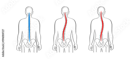 Scoliosis spine deformity