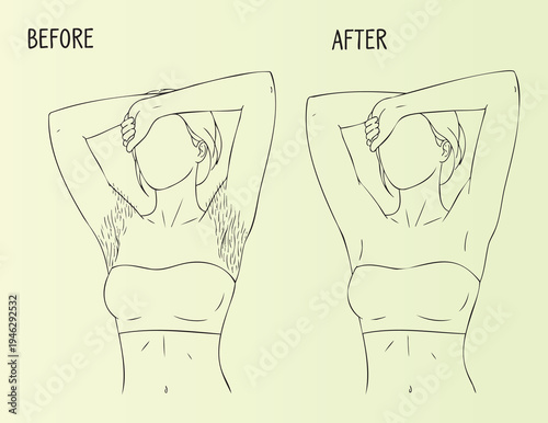 Before and after illustration of underarm hair removal process
