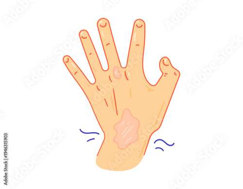 Illustration of a hand with a red rash. The skin on the hand is infected with a fungus, eczema, dermatitis, ringworm, or athlete's foot. Skin diseases and health problems. Flat style illustration 