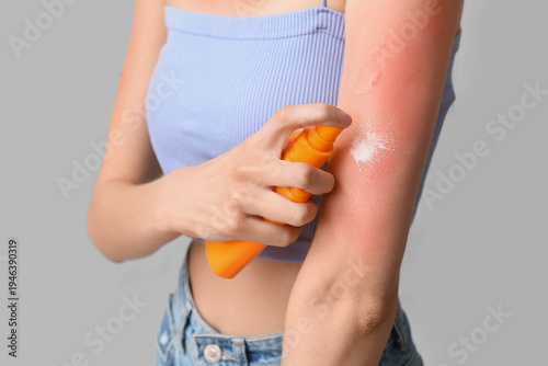 Konstfotografi Young woman with red sunburned skin applying cream on grey background, closeup