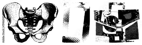 Anatomical hip bone rendered in halftone dots, layered with abstract geometric shapes, stylized vector art, medical illustration aesthetic, black and white.