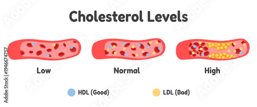 Cholesterol levels infographic showing low, normal and high cholesterol in artery with HDL and LDL particles. Cardiovascular health concept. Vector illustration