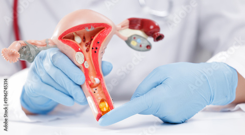 Quadro su tela Closeup of gynecologist gloved hands pointing at uterine anatomical model use vi