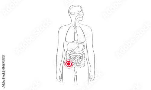 Inflamed appendix scetch
