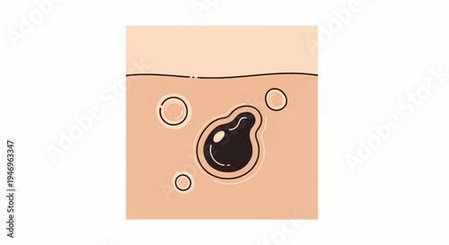 Illustration of skin with enlarged pores and a blackhead, showing a microscopic view of a skin condition