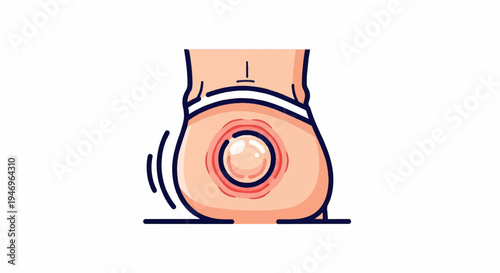 Simple illustration of a human torso showing an inflamed skin blister or boil with surrounding redness