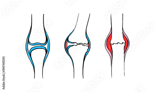 Arthritis Sketch Poster