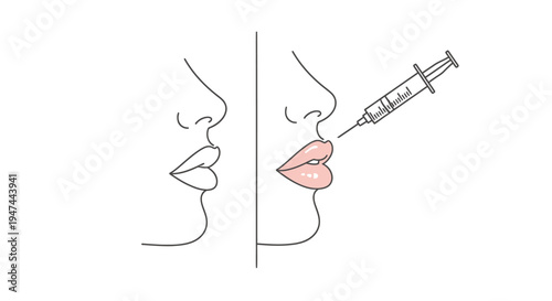 Minimalist Lip Injection Concept Illustration with Needle. Vector Illustrations. EPS Editable