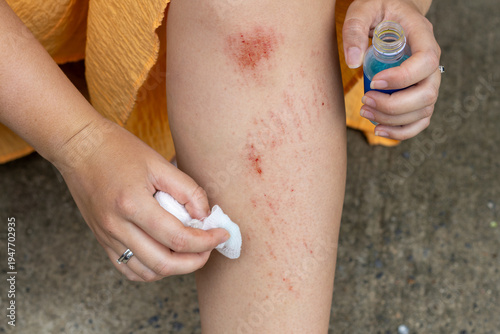 Foto Close-up of a hand applying antiseptic with a cotton pad to scrapes and abrasions on a leg while holding a blue bottle, showing basic first aid for minor skin injuries