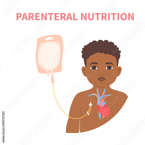 Young patient receiving parenteral nutrition through a central intravenous IV access. Clinical feeding therapy in critical care for malnourished pediatric patients in hospitals. Vector illustration.