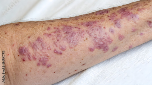 Close up view of human arm skin affected by lichen planus